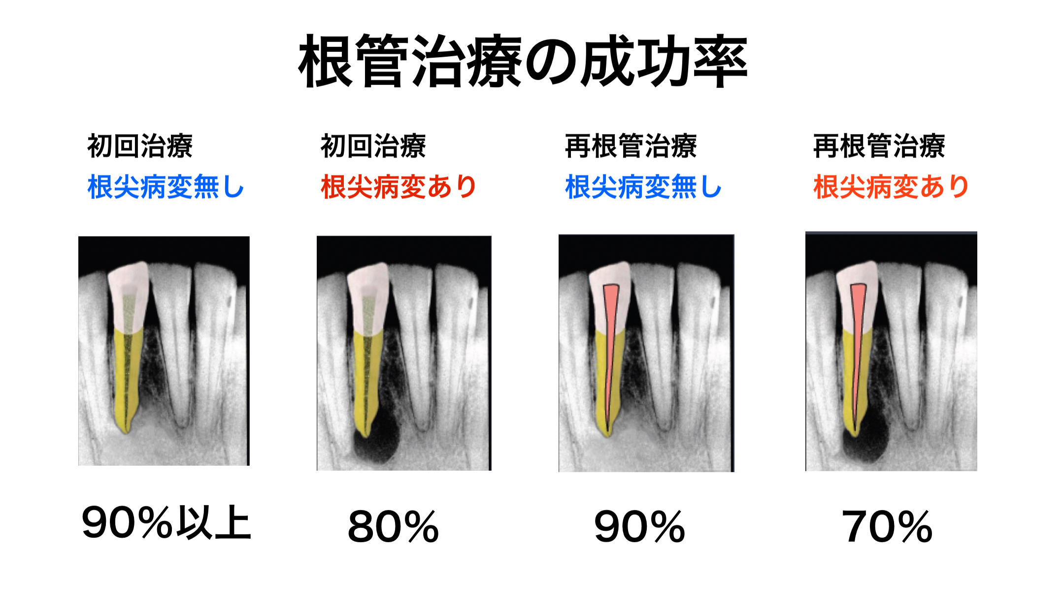 再発・感染リスクを下げる！誰でもできる米国式根管治療テクニック 感染根管治療(リトリートメント)｜都島にある根管治療大阪クリニック