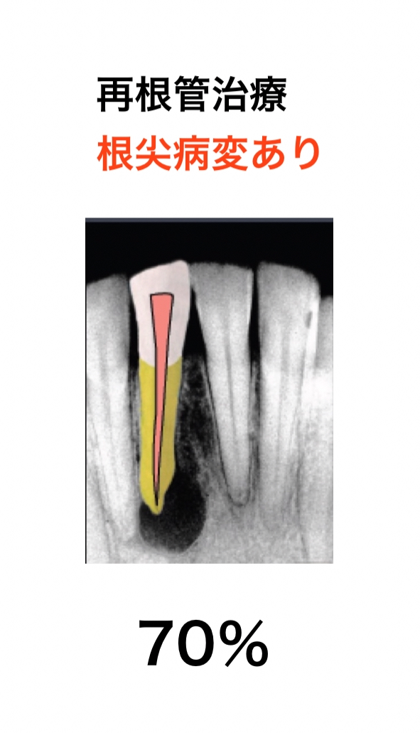 ⚠裁断済　根管治療で失敗する本当の理由 難症例・トラブル・再根管治療を克服する… あなたの根管治療はここがまちがっている! | 鶴町 保 |本 | 通販