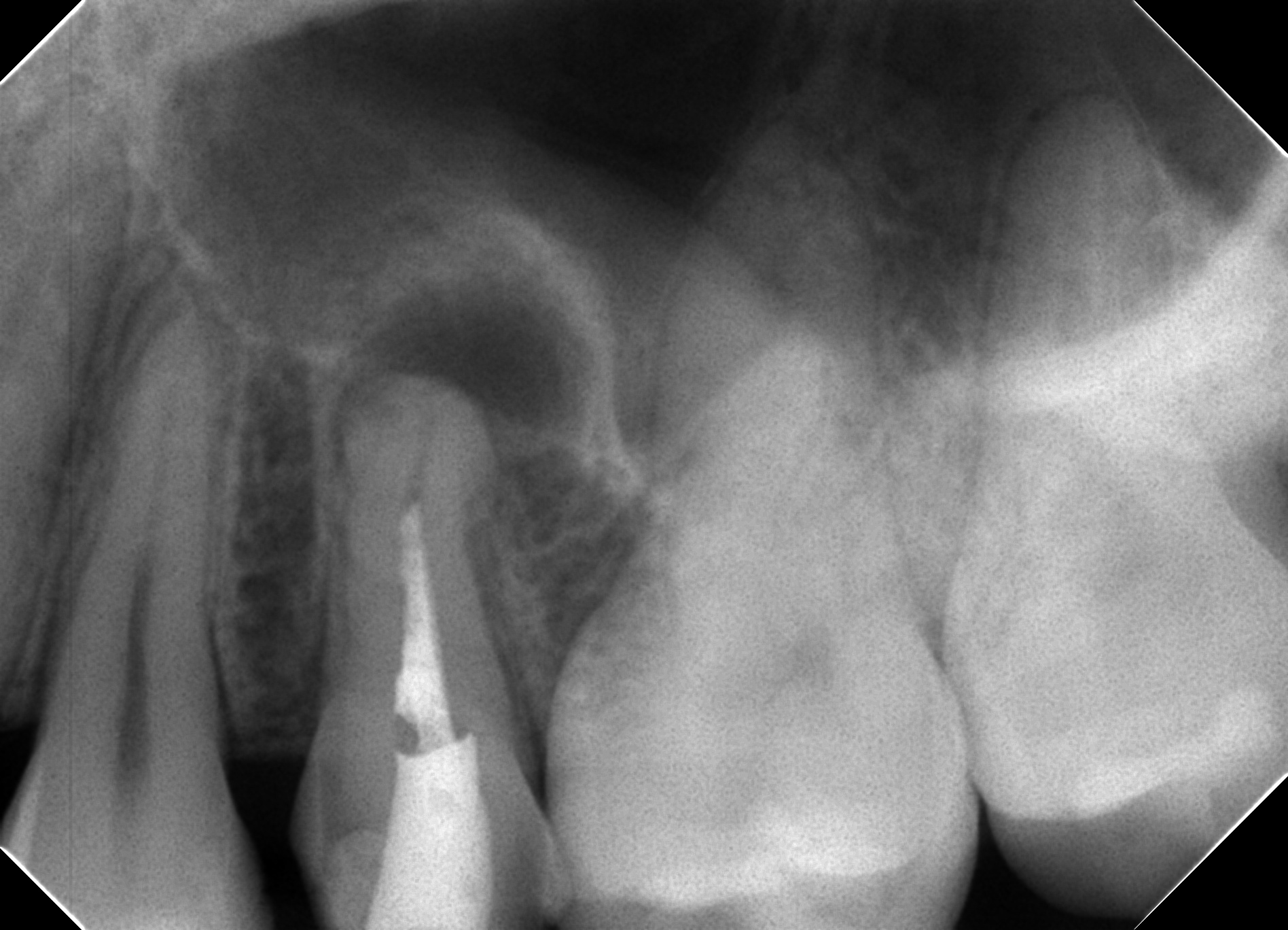 長期経過症例から紐解く根尖病変と骨縁下欠損 長期経過症例から紐解く根尖病変と骨縁下欠損 | 下川 公一, 倉富